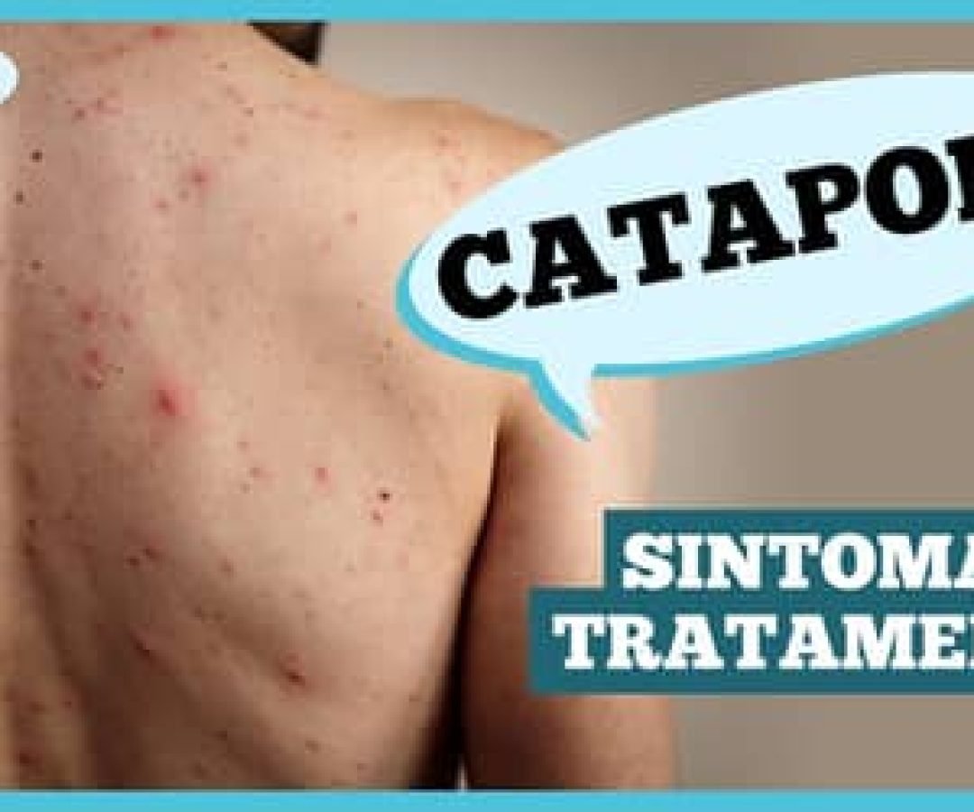 Cataporasintomascomplicaesepreveno_0098889001763344638.jpeg