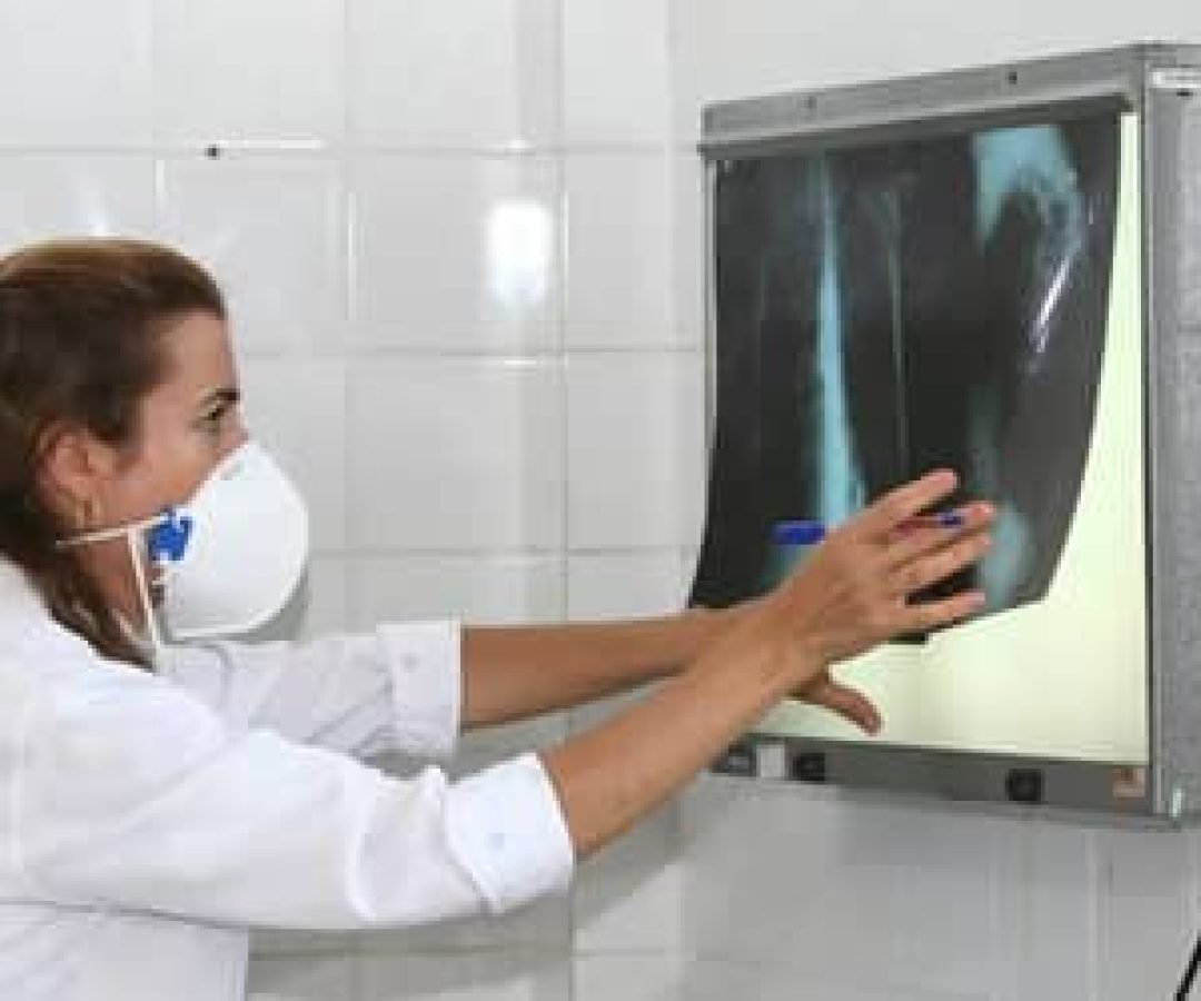 TuberculoseAmazonaslideraincidncianoBrasilseguidoporRoraimaeRiodeJaneiro_0737155001763344641.jpeg